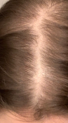 Nutrafol (6 Months)  — after
