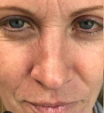 Geneo + Cryo Facial Treatment(2 Visits)  — before