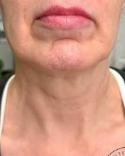 AgeJet Nitrogen Plasma (2 Sessions, High Intensity)  — before