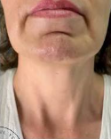 AgeJet Nitrogen Plasma (2 Sessions, High Intensity)  — after