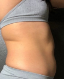 EMSLim Body (7 Sessions)  — before