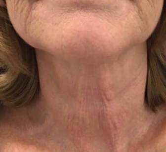 HIFU (4 Sessions)  — after