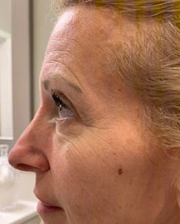 Pro Clinical Peel (4 Sessions)  — before