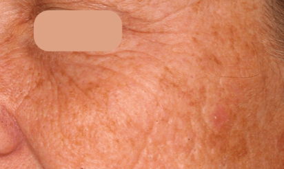 AcuPulse co2 (2 Sessions) — before