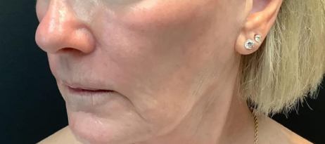 AcuPulse co2 (2 Sessions)  — after