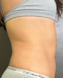 EMSLim Body (7 Sessions)  — after
