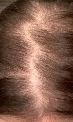 Nutrafol (6 Months)  — before