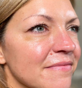 triLift (5 Sessions) — before