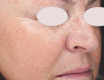 Stellar M22 IPL+resurFX (4 Sessions)  — after