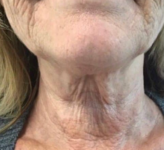 HIFU (4 Sessions)  — before