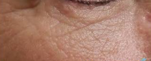 Microneedling (3 Sessions) — after