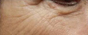 Microneedling (3 Sessions) — before