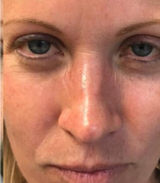 Geneo + Cryo Facial Treatment(2 Visits)  — after