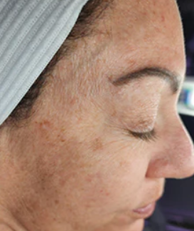 Perfect Derma Peel AA Booster (2 Sessions)  — before