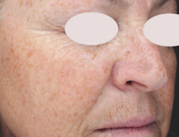 Stellar M22 IPL+resurFX (4 Sessions)  — before