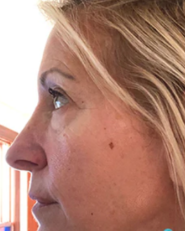 Pro Clinical Peel (4 Sessions)  — after