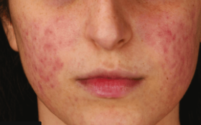 AcuPulse co2 (3 Sessions)  — before