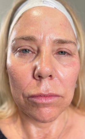 triLift (Full Series 8 Session + 2 RF Microneedling)  — before