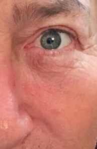 Perfect Derma Peel AA Booster (4 Sessions)  — after