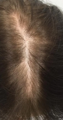 PRP Hair Restoration (4 Sessions)  — after