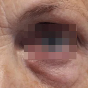 triLift Eyes (4 Sessions) — before