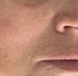 Stellar M22 IPL (5 Sessions)  — after