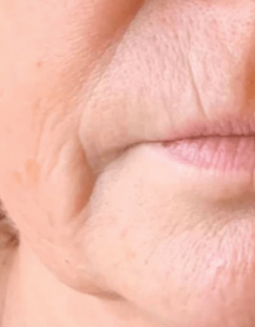 triLift (3 Sessions) — before