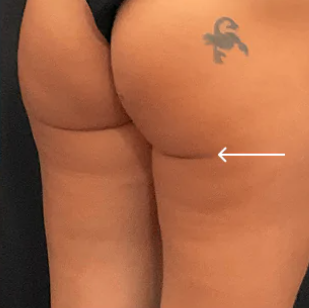triLift Body (4 Sessions Buttocks) — after
