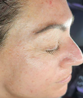 Perfect Derma Peel AA Booster (2 Sessions)  — after