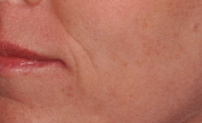 AcuPulse co2 (2 Sessions)  — after