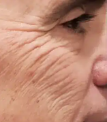 AgeJet Nitrogen Plasma (2 Sessions, High Intensity)  — before