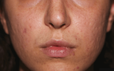 AcuPulse co2 (3 Sessions)  — after