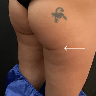 triLift Body (4 Sessions Buttocks) — before