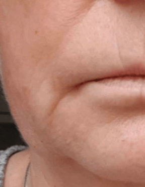 triLift (3 Sessions) — after