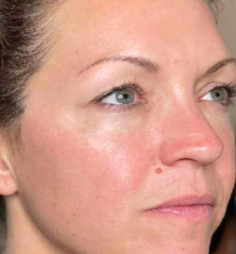 triLift (5 Sessions) — after