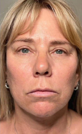 triLift (Full Series 8 Session + 2 RF Microneedling)  — after