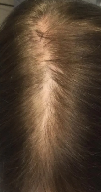 PRP Hair Restoration (4 Sessions)  — before