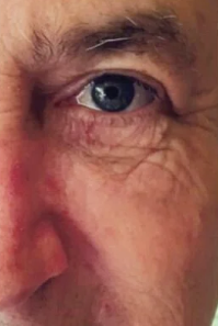 Perfect Derma Peel AA Booster (4 Sessions)  — before
