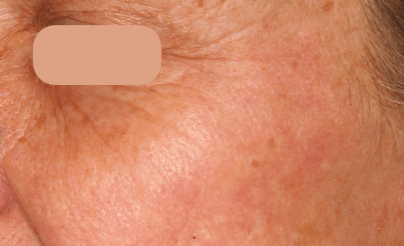 AcuPulse co2 (2 Sessions) — after