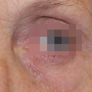 triLift Eyes (4 Sessions) — after