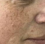 Stellar M22 IPL (5 Sessions)  — before
