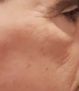 AgeJet Nitrogen Plasma (2 Sessions, High Intensity)  — after
