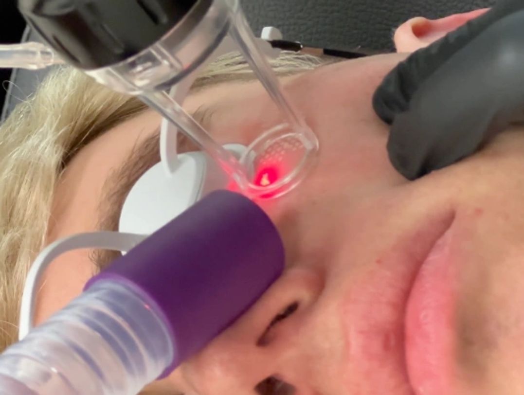Acupulse CO2 Laser