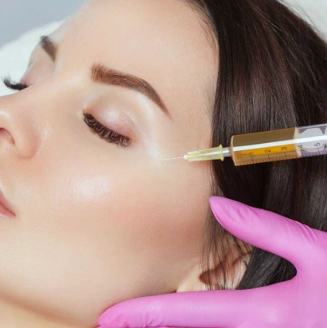 Microneedling with PRP