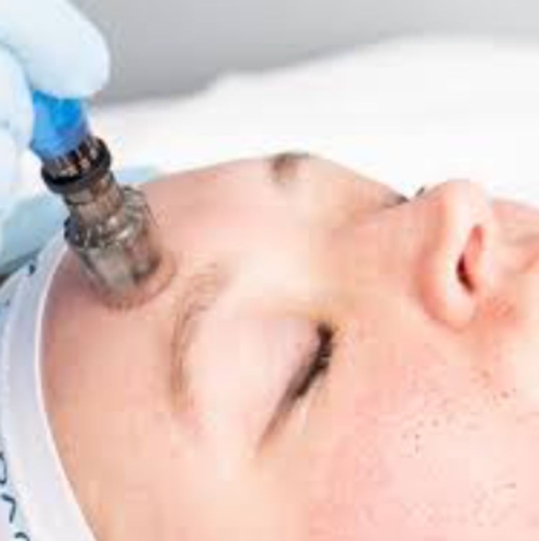 Microneedling