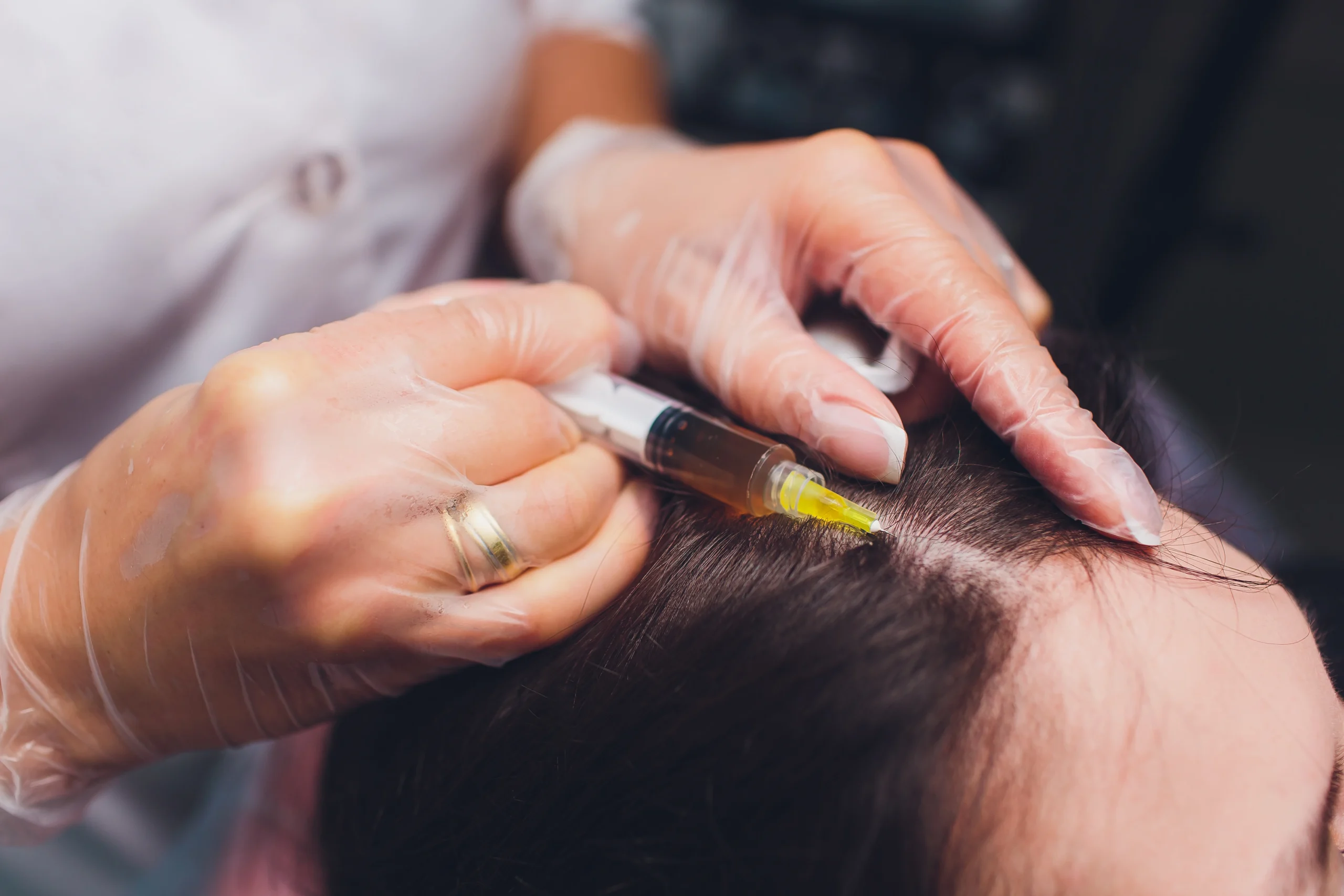 PRP Treatment at Iridescent Medical and Wellness Spa in Clinton Twp, MI