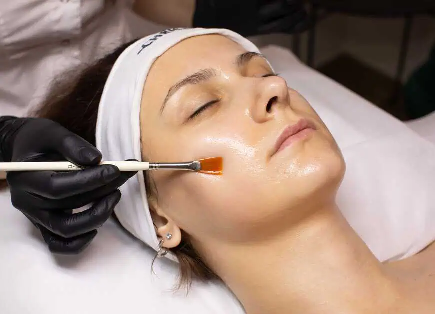 Chemical Peels in Clinton Twp, MI by Iridescent Medical and Wellness Spa