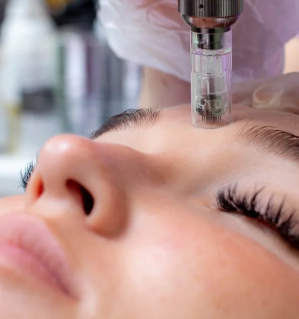 Microneedling Treatment in Clinton Twp, MI